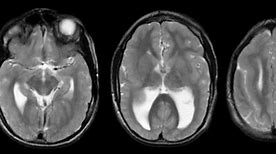 Image result for Lissencephaly in Adults