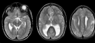 Image result for Lissencephaly with Cerebellar Hypoplasia