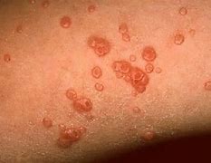 Image result for Molluscum On Knuckles