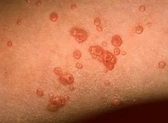 Image result for Molluscum On the Leg