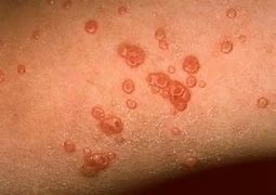 Image result for Molluscum Contagiosum in Adults Wallgreensns