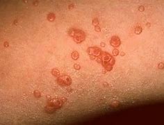 Image result for Molluscum Contagiosum Rash