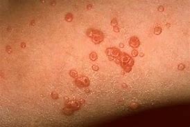 Image result for Molluscum Contagiosum Virus in Ethiopia