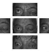 Image result for Upper Eyelid Lesions