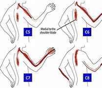 Image result for C5 C6 Symptoms Nerve Chart