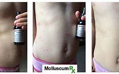 Image result for Natural Molluscum Treatment