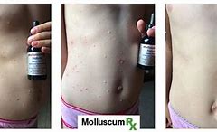 Image result for Molluscum Contagiosum Beetlejuice Treatment