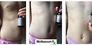 Image result for Molluscum Contagiosum Herbal Treatment