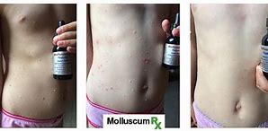 Image result for Molluscum Contagiosum Stages of Healing
