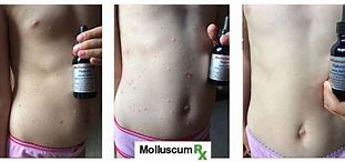 Image result for Child Molluscum Contagiosum Treatment