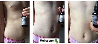 Image result for How to Get Rid of Molluscum Contagiosum
