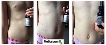 Image result for Molluscum Contagiosum Infection Treatment