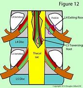 Image result for Exiting Nerve Root