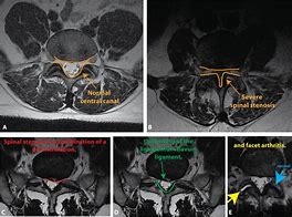 Image result for Full Spine MRI