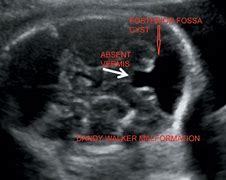 Image result for Proteus Syndrome Fetal Ultrasound