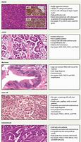 Image result for Epithelial Ovarian Tumors List