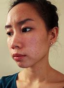 Image result for Allergic Skin Reactions On Face