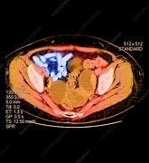 Image result for Ovarian Cancer CT Scan
