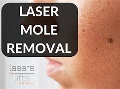 Image result for Flat Mole Removal