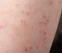 Image result for Symptom Itchy Skin Rashes