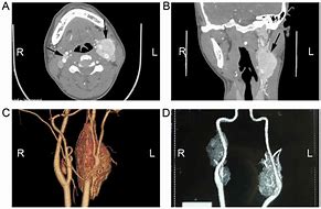 Image result for Carotid Tumor Neck