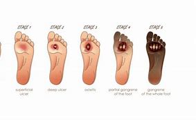 Image result for Diabetic Foot Sores