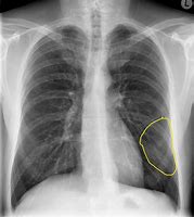 Image result for Chlamydial Pneumonia