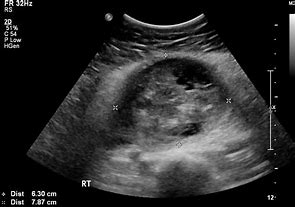 Image result for Solid Ovarian Mass Ultrasound