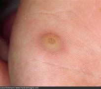 Image result for Verruca On Sole of Foot