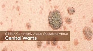 Image result for Male Genital Warts Stages