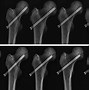 Image result for Femoral Neck Fracture Types