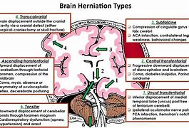Image result for Brain Uncal Herniation