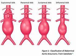 Image result for AAA Types