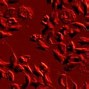 Image result for Sickle Cell Disease Genetics