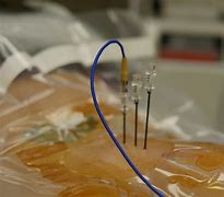 Image result for Radiofrequency Ablation Needle