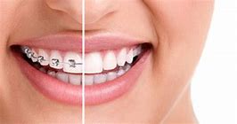 Image result for Straight Teeth with Braces