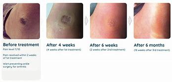 Image result for Compound W Wart Removal Stages