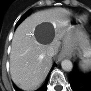 Image result for Hepatic Cysts Liver