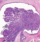 Image result for Fungiform Papilloma