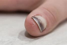 Image result for Smashed Fingernail