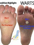 Image result for Verruca On Sole of Foot
