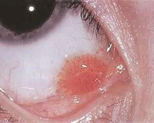 Image result for Papilloma Eye