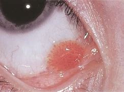Image result for Squamous Papilloma Eyelid Histology