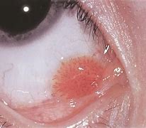 Image result for Conjunctival Papilloma Eyelid Histology