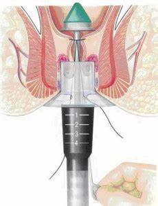 prolasso rettale interno sintomi prolasso rettale specialista in colon proctologia prolasso rettale interno sintomi prolasso rettale specialista in colon proctologia