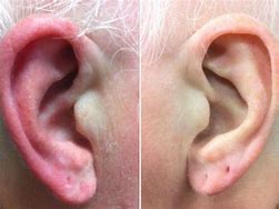 Image result for Seborrheic Wart Ear
