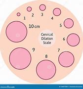 Image result for 21 FR Dialated Cervix Graphic