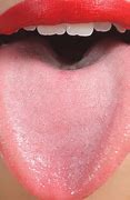 Image result for White Growth On Tongue