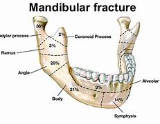 Image result for Jaw Bone Fracture