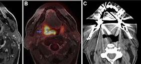 Image result for Head and Neck Cancer MRI